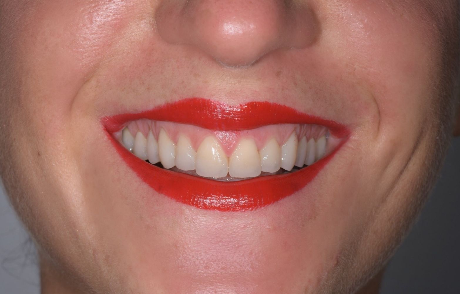 sorriso dopo