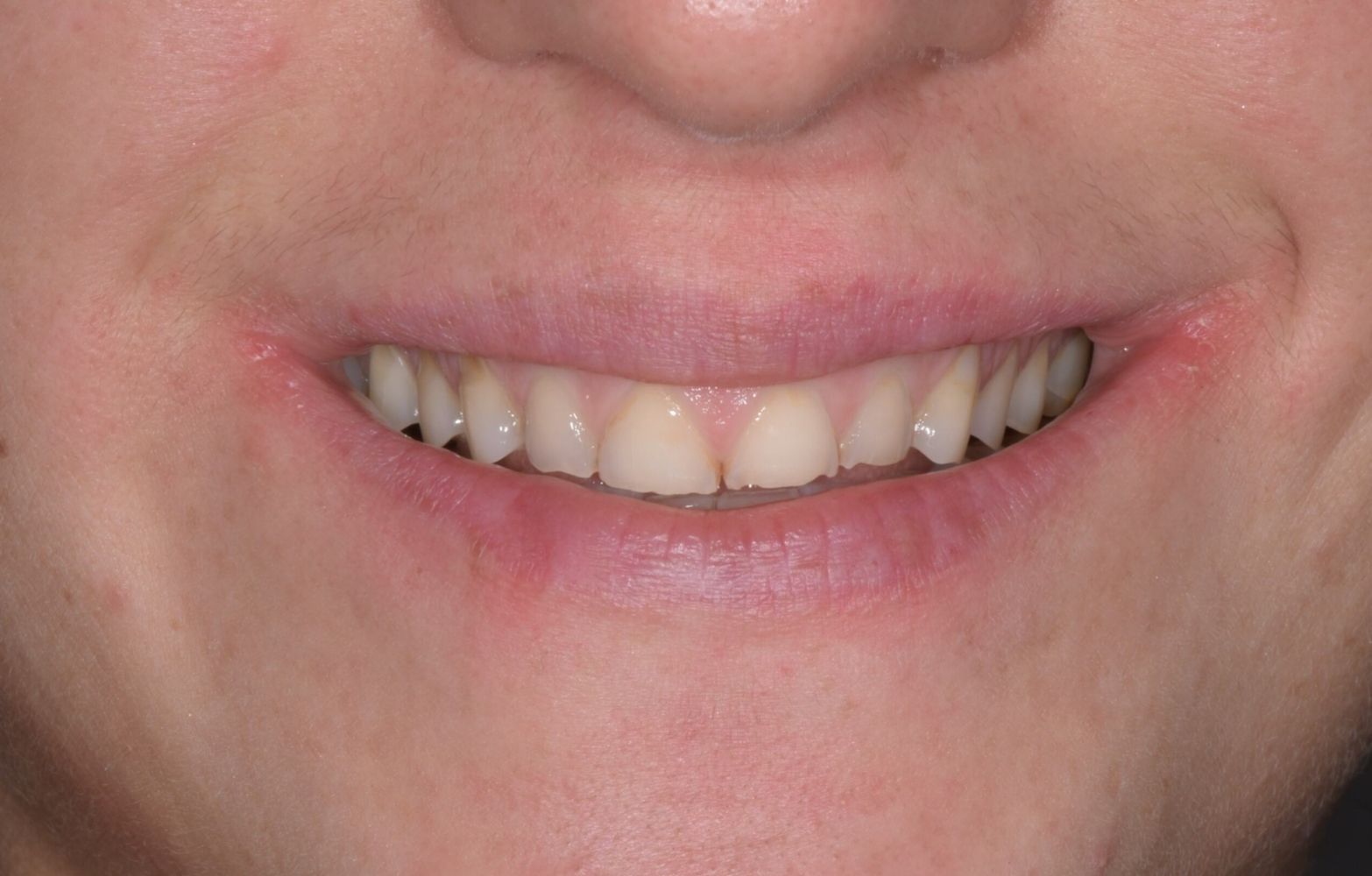 sorriso prima sorriso prima